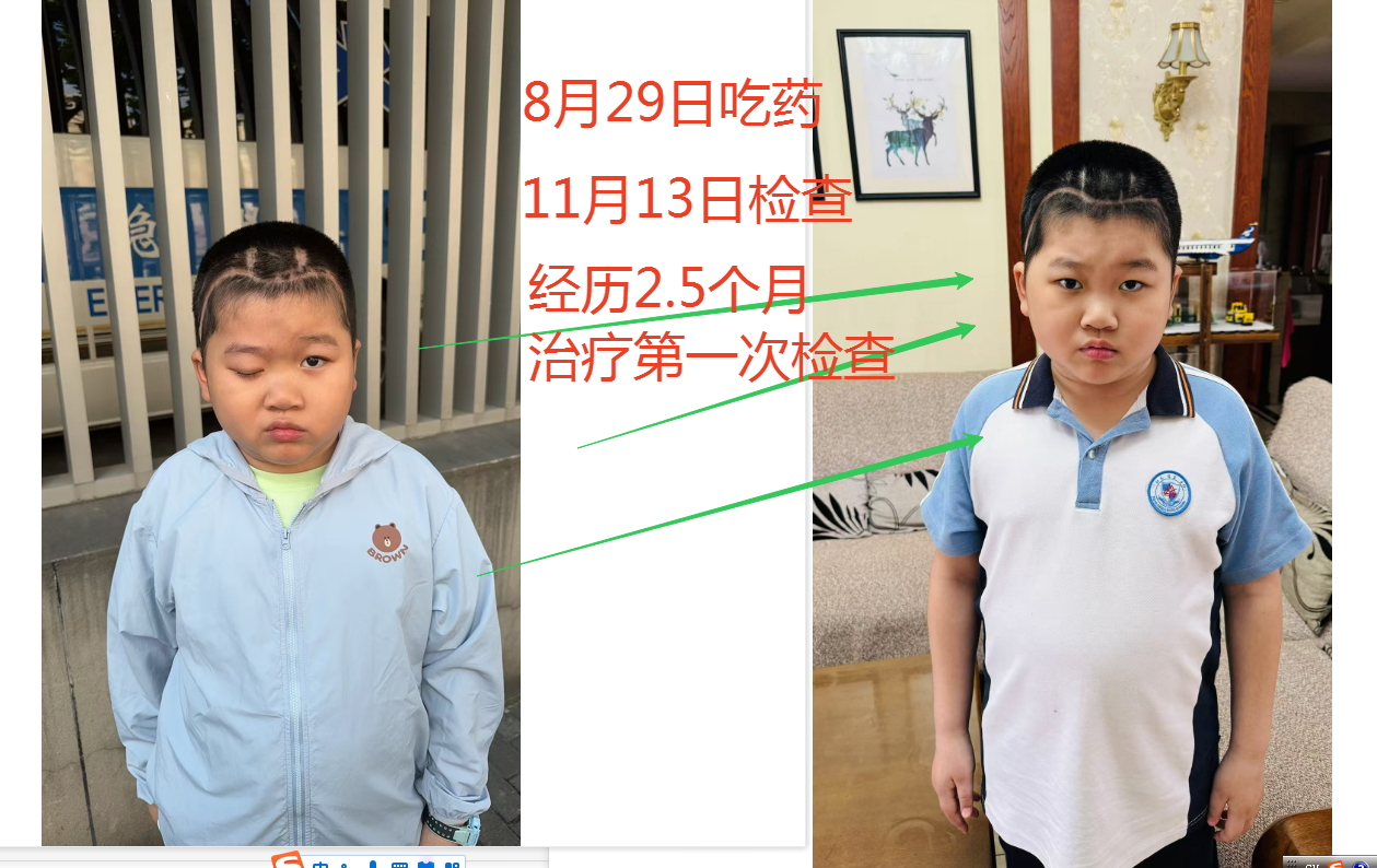 8.29吃安罗替尼，11.13复查，历经2.5个月，有效果，但是复查结果大小不变，继续吃药3个月后复查